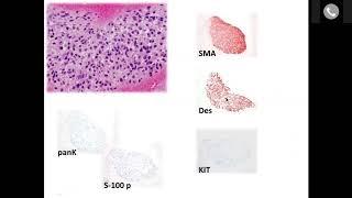 Basic Lecture on Pathology of Sarcoma - Video Thumbnail